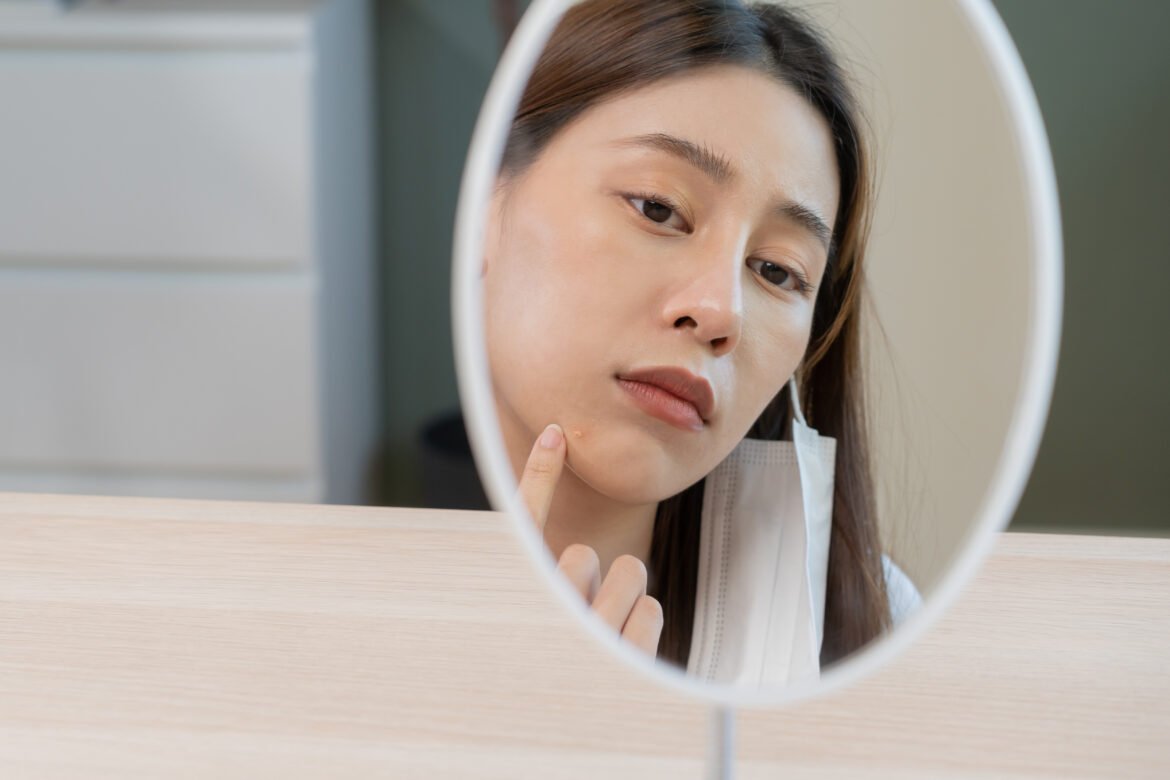 Kaip greitai atsikratyti spuogų — greiti būdai pašalinti inkštirus ir aknę